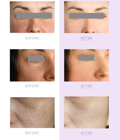Rejuva PN 1% Eye 1x2ml